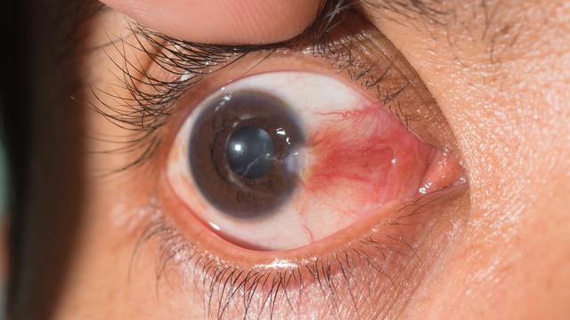 Pterygium