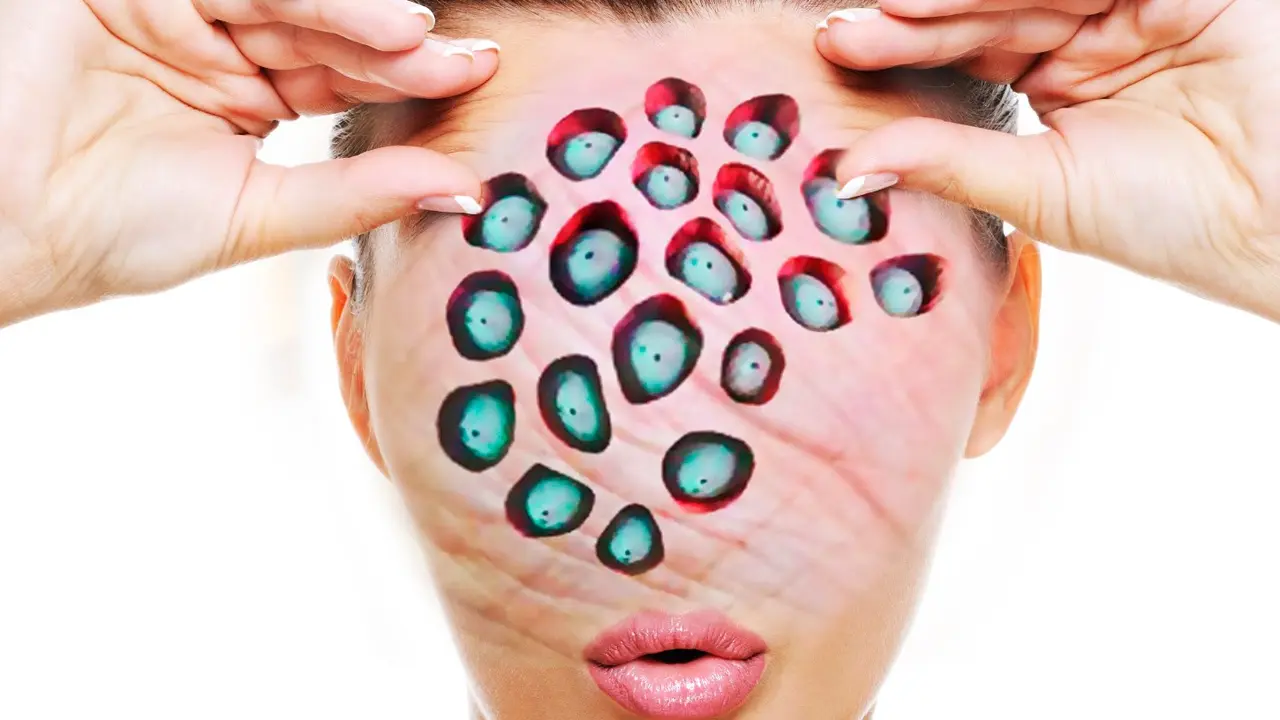 Penyebab Trypophobia
