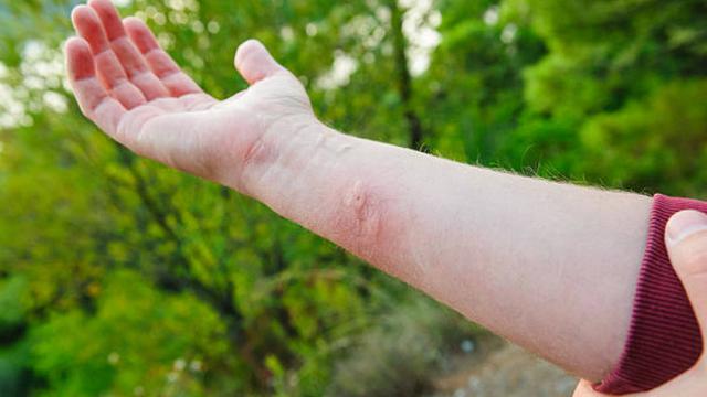 Pertolongan Pertama Bila Digigit Hewan Rabies, Perhatikan Langkah-Langkahnya