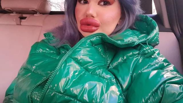 Ingin Tampil Bak Boneka, Wanita Akan Injeksi Bibir Ke 27 Kali Akhir Tahun Ini