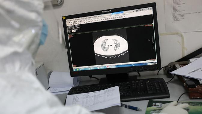 Dokter melihat gambar CT di bangsal isolasi Rumah Sakit Palang Merah di Wuhan, 16 Februari 2020. Virus Corona yang bermula di China tengah pada Desember 2019 kini menyebar secara global di mana lima negara terdampak paling besar, yakni Cina daratan, Korea Selatan, Iran, Italia dan Jepang (STR/AFP)