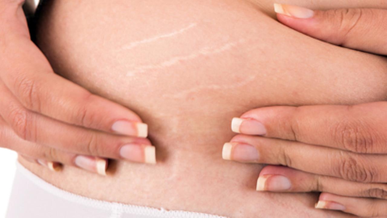 Kebiasaan yang Menyebabkan Selulit