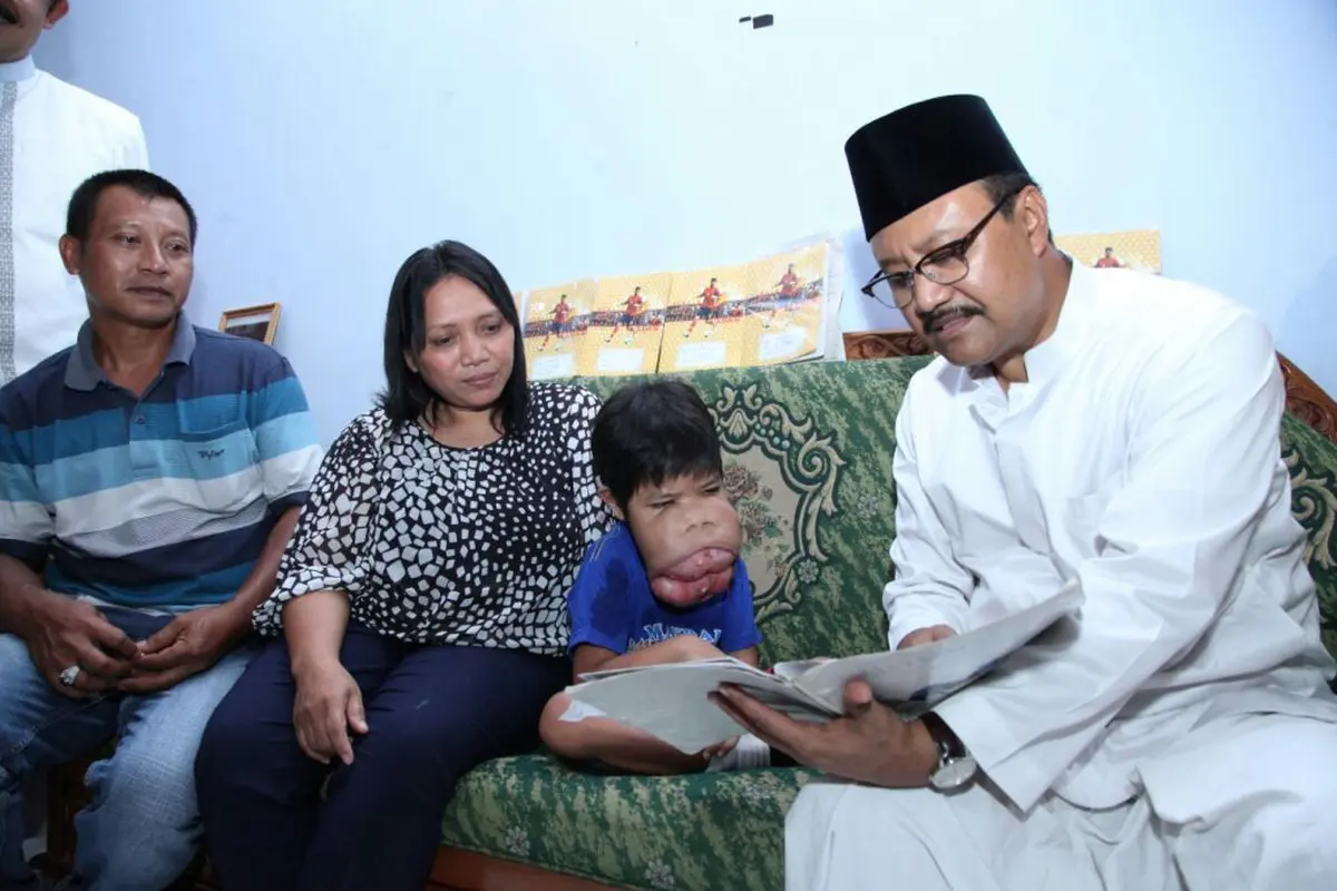 Bintang, Penderita Tumor Gusi Asal Blitar
