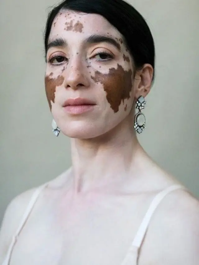 model vitiligo