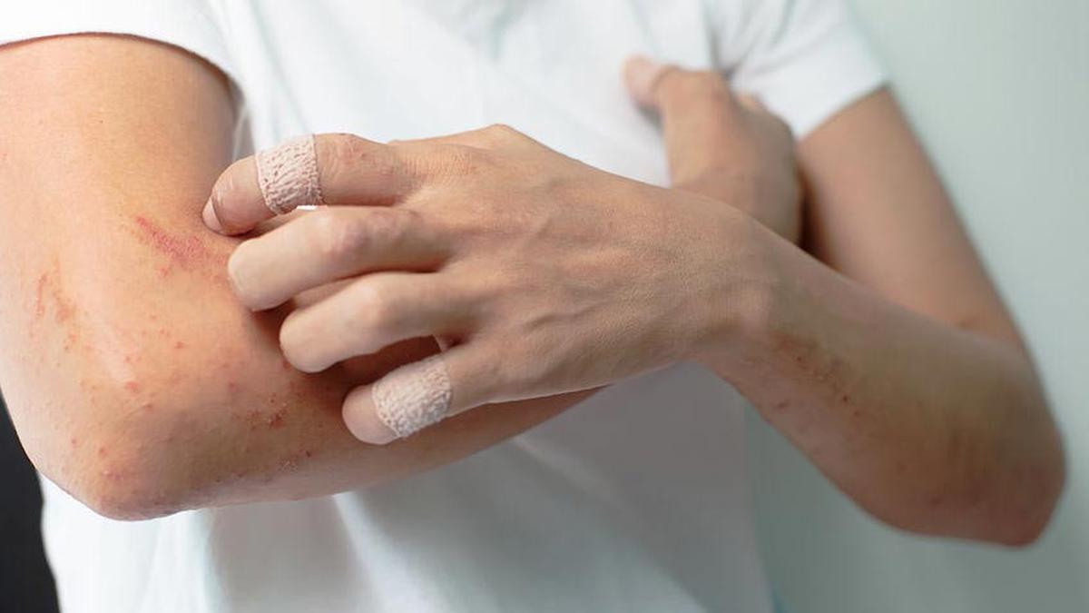 Gambar Biang Keringat menunjukkan area kulit yang terkena biang keringat dengan bintik-bintik merah kecil, umum terjadi di daerah yang sering berkeringat seperti leher dan punggung