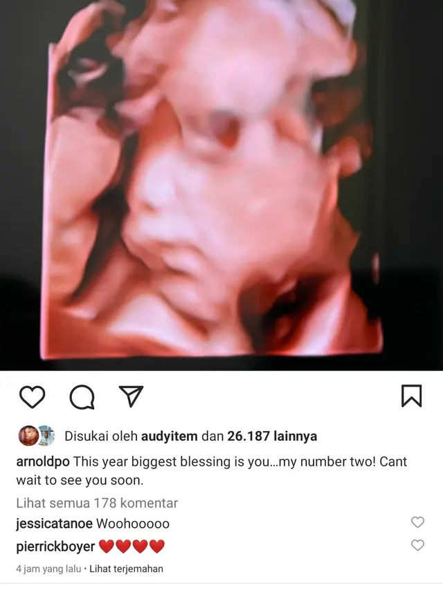 Chef Arnold dan Istri Umumkan Hamil Anak Kedua (Sumber: Instagram/arnoldpo)