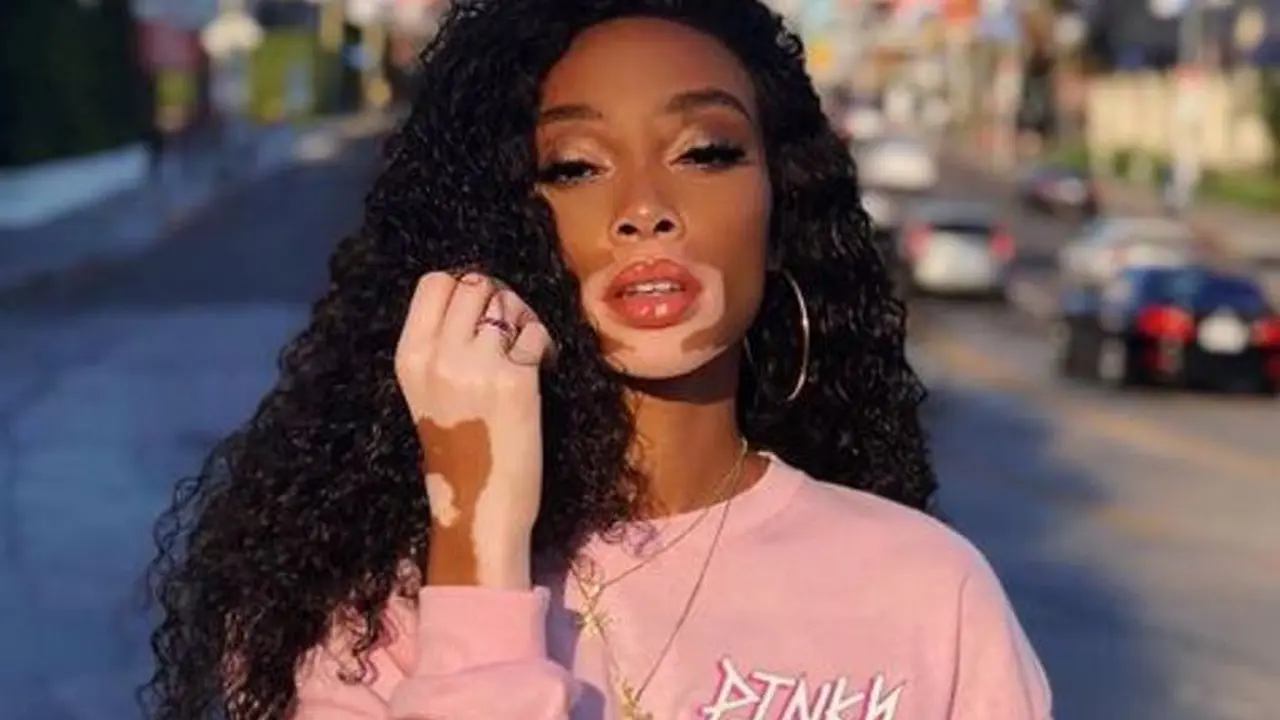 [Fimela] Perjalanan Panjang Winnie Harlow Sebelum Jadi Model Victoria’s Secret