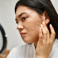 Ilustrasi perempuan berjerawat. (c) AllaSerebrina/Depositphotos.com