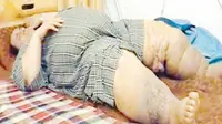 Humood, pria Saudi berusia 48 tahun yang mengalami obesitas hingga bobot lebih dari 300 kg. (Al Jazeera)