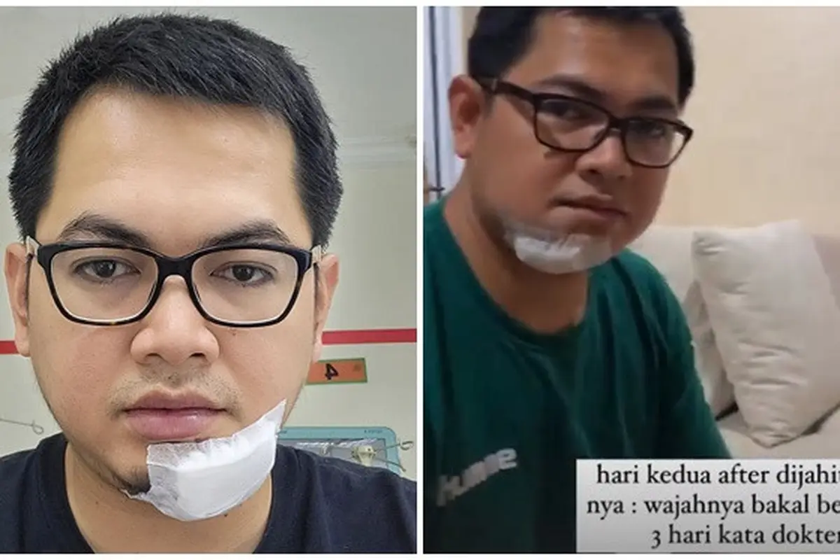 Jatuh hingga Alami Robek di Dagu, Ini 6 Potret Kondisi Tommy Kurniawan