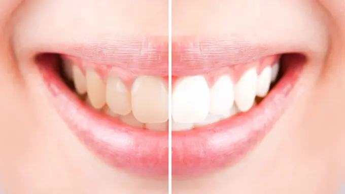 Cara Ampuh Bersihkan Gigi Kuning secara Alami