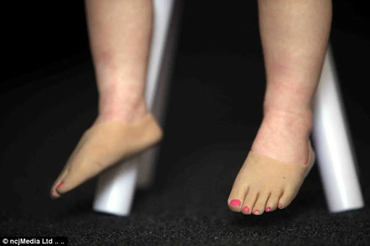 Kehilangan Kaki, Gadis Mungil Ini Tetap Ingin Berjalan dan Menari