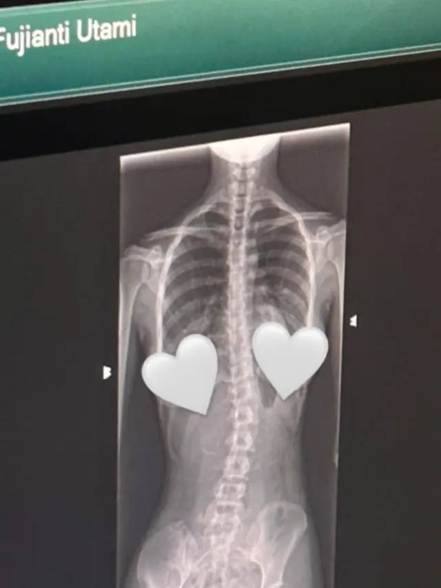 Fuji Menangis usai Tahu Idap Skoliosis, Kenali Penyebab dan Gejalanya