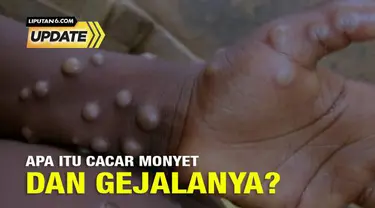 Selain hepatitis akut, pemerintah kini tengah waspada terhadap cacar monyet yang mewabah di beberapa negara. Kasus pertama yang terkait dengan wabah cacar monyet saat ini dilaporkan di Inggris pada 7 Mei dari seseorang yang baru-baru ini bepergian ke...