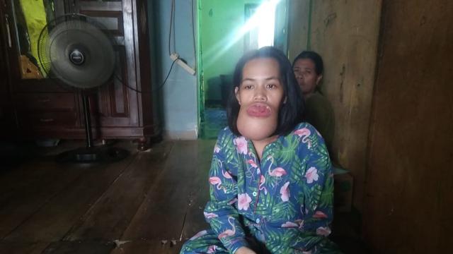 Remaja di Palembang Putus Sekolah Usai Divonis Idap Tumor Mandibula