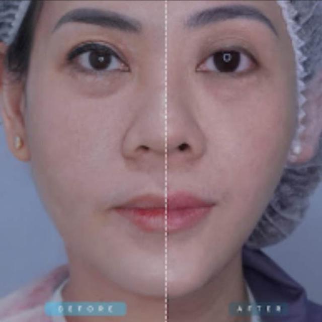 Inovasi Treatment Wajah Tirus Tanpa Benang