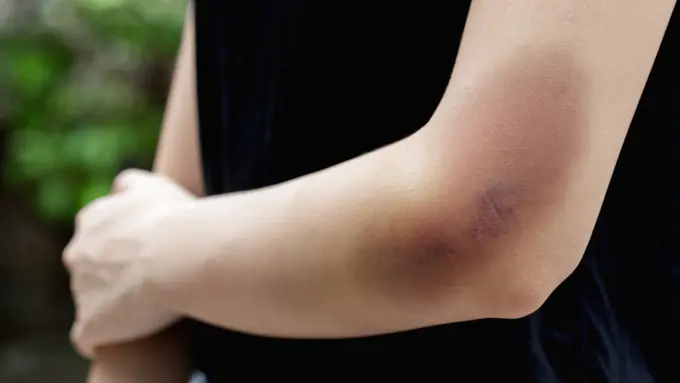 3 Hal yang Bisa Kamu Lakukan Untuk Menghilangkan Memar