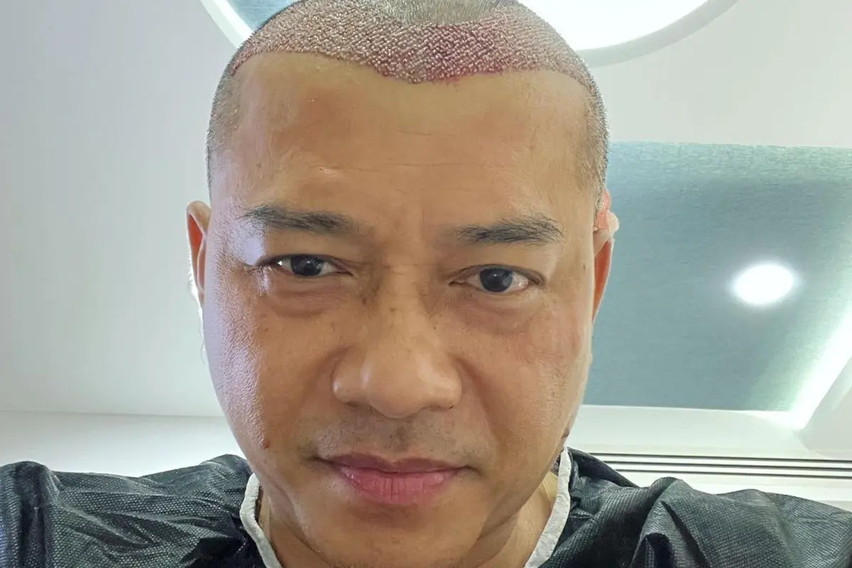 Anang dan Atta Halilintar lakukan transplantasi rambut, begini cara kerjanya