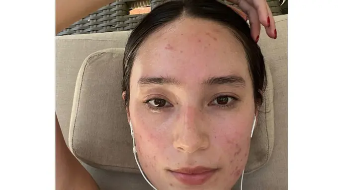 Tatjana Saphira bagikan foto wajah bekas jerawat