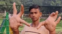 Punya Tangan Berukuran Raksasa, Remaja Ini Dijuluki "Hulk" Asal India (India Times)