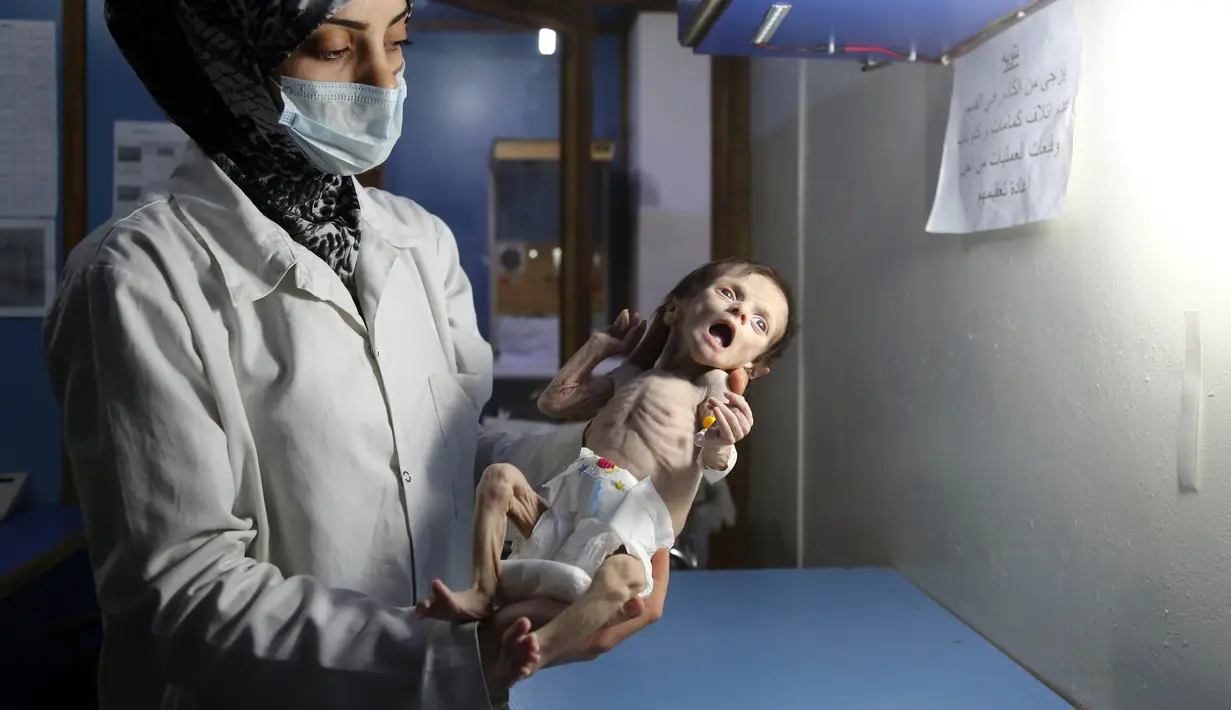 Sahar Dofdaa, bayi Suriah yang menderita kekurangan gizi parah digendong perawat di sebuah klinik pinggiran kota Damaskus, yang dikuasai oposisi, 21 Oktober 2017. Foto bayi malang dengan kondisi menyedihkan itu menjadi sorotan luas. (Amer ALMOHIBANY/AFP)