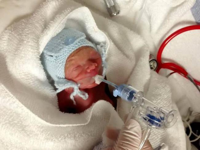 Jet bayi prematur dalam perawatan | Photo: Copyright metro.co.uk