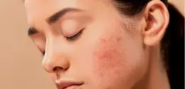 Ilustrasi Masalah Jerawat Credit: pexels.com/Molly