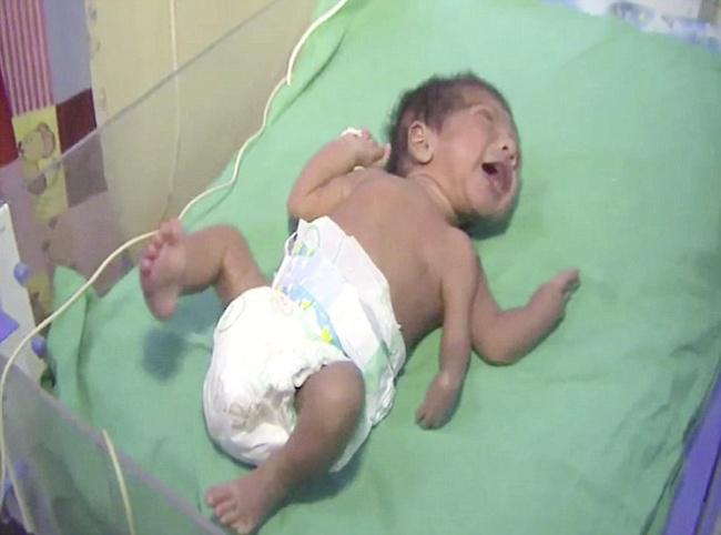 Kondisi bayi ebelum di operasi | foto copyright dailymail.co.uk