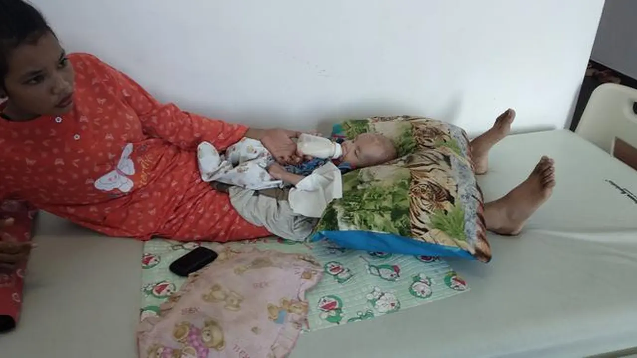 Bayi Gizi Buruk