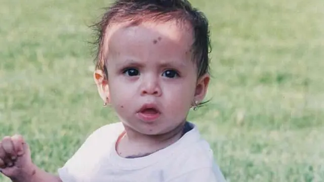 [Bintang] Kisah Wanita yang Ingin Bunuh Diri karena Memiliki Tanda Lahir Hampir di Sekujur Tubuh