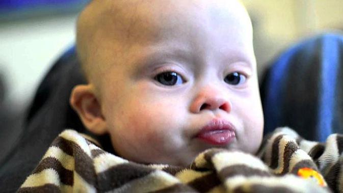 Ciri Bayi Yang Menderita Gangguan Tiroid Health Liputan6 Com