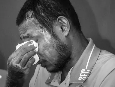 Pemain Malaysia, Faisal Halim menyeka matanya saat jumpa pers pemusatan latihan Selangor FC di Padang SUK Shah Alam, Kamis (13/6/2024). Terlihat luka bakar di sejumlah bagian tubuhnya akibat insiden penyiraman air keras oleh orang yang tak dikenal pada 5 Mei 2024. (AFP/Arif Kartono)