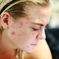 Ilustrasi jerawat. Sumber foto: pixabay.com/Kjerstin Michaela.