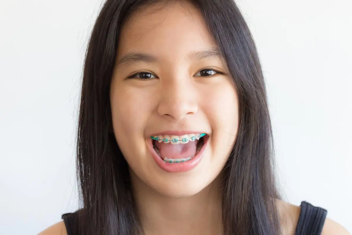 Usia Berapa Anak Boleh Memakai Kawat Gigi? (Toey Toey/Shutterstock)