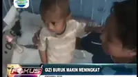 Jumlah Balita Bergizi Buruk Masih Tinggi di Indonesia