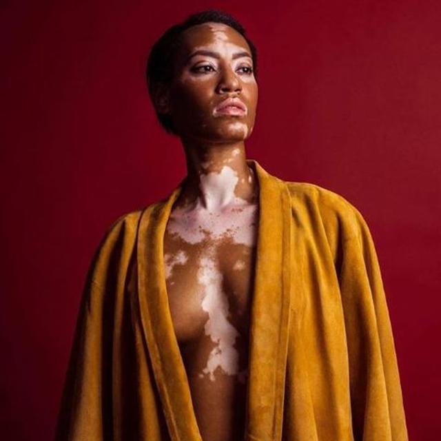 Tidak Menular Dan Mematikan Seberapa Bahaya Vitiligo Health