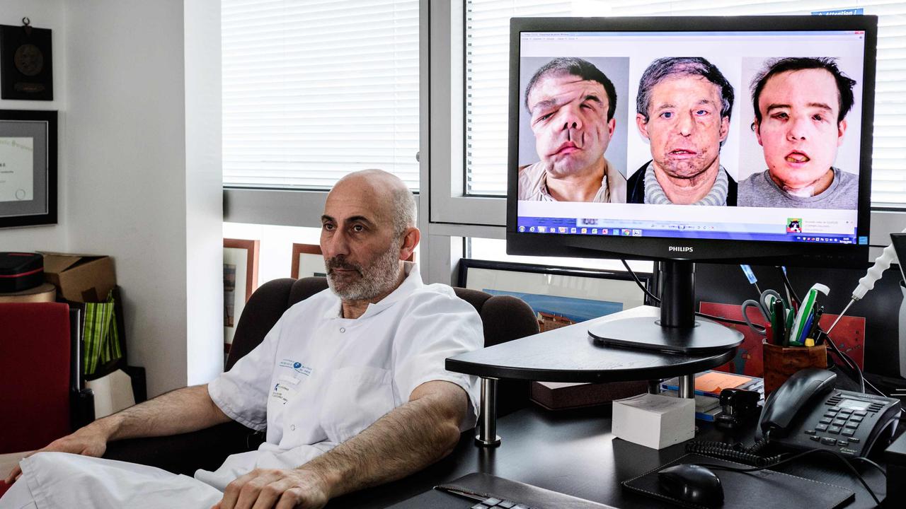 Transplantasi Wajah-Jerome Hamon