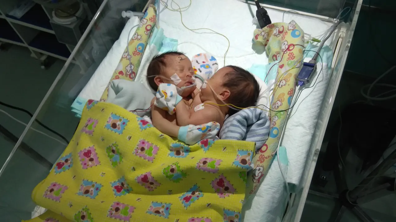Bayi Kembar Siam Salma-Sovia Mulai Hirup Udara Bebas