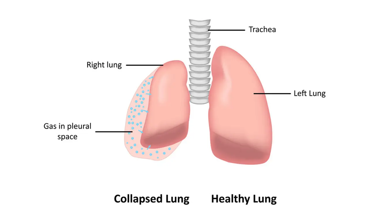 Pneumothorax