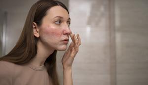 Rosacea Bikin Wajah Merah dalam Jangka Panjang, Kenali Gejala hingga Cara Mengatasinya. Foto: Freepik.