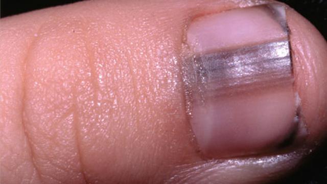 [Bintang] Ketahui 7 Kondisi Kuku yang Mencerminkan Kesehatanmu