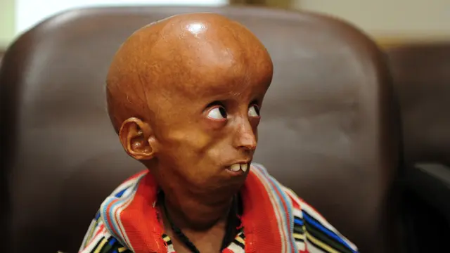 20170502-Rupesh, Pasien Progeria di India-AFP