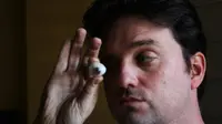 Harus menggunakan mata prostetik, Rob Spence justru berkreasi menciptakan bola mata prostetik yang dilengkapi kamera.
