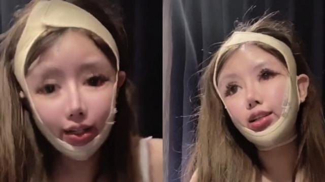 Zhou Chuna disebut sebagai 'pecandu' operasi plastik termuda di China