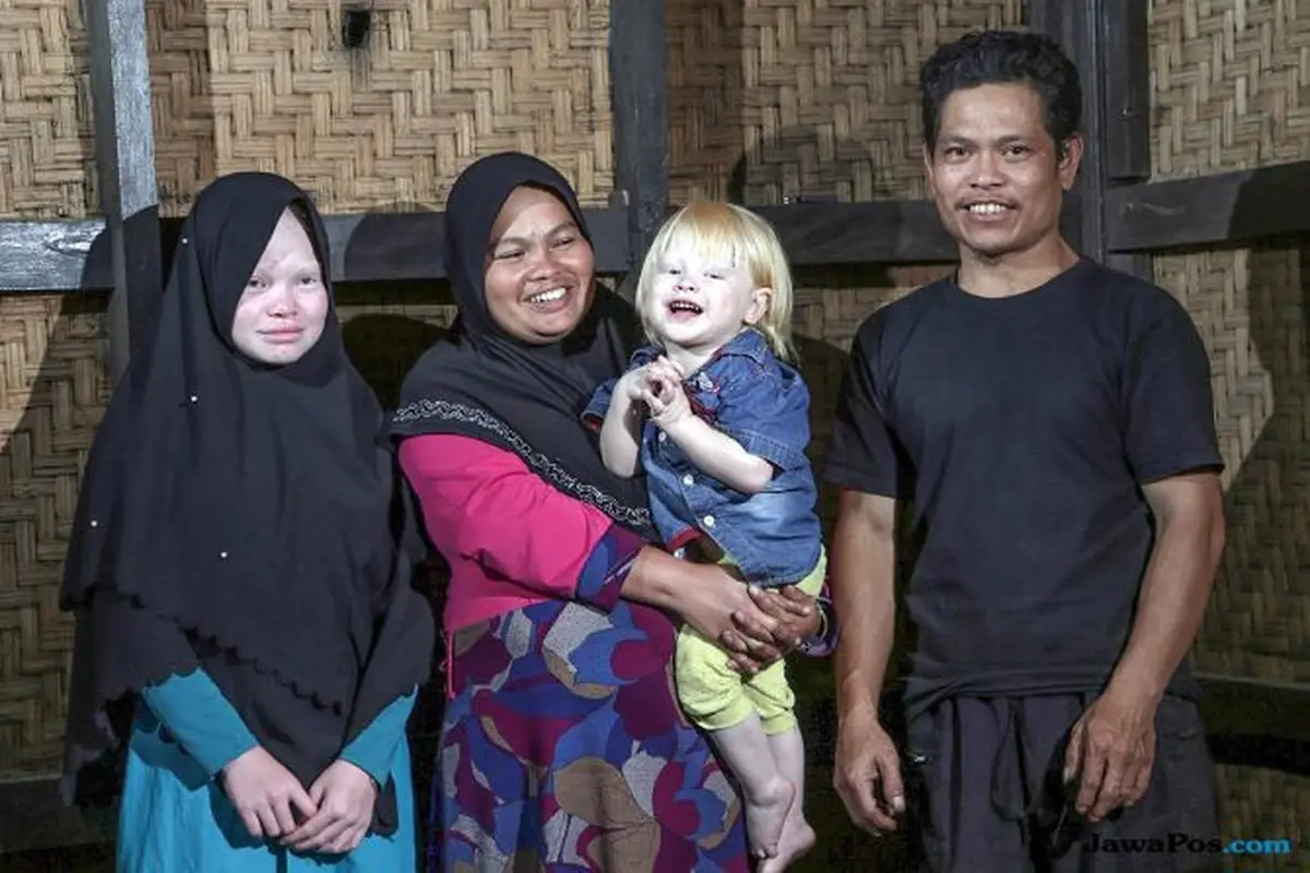 Curhat Warga Kampung Albino Dirundung Gara-Gara Warna Kulit