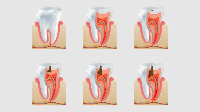 Ilustrasi proses terjadinya gigi berlubang