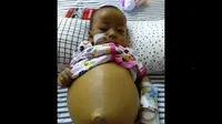 Perut bayi Syahreza terus membesar akibat penyakit pembengkakan hati. (Liputan6.com/Bangun Santoso)