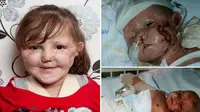 Seorang gadis kecil yang manis terpaksa harus kehilangan kedua kaki dan lengannya karena virus mematikan, meningitis.