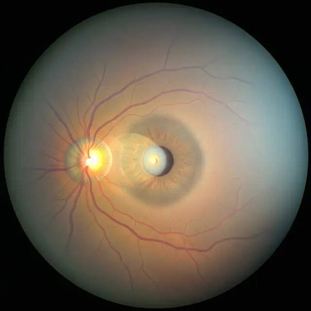 Retinopati Surya (Gemini AI)