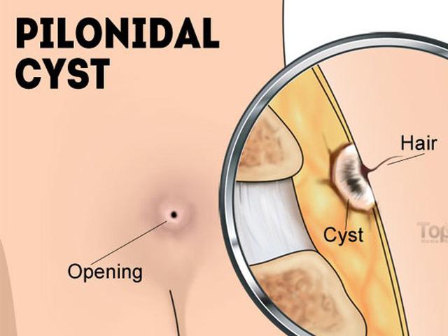 Cara Mengobati Kista Pilonidal - Health Liputan6.com